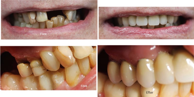 Före och efterbilder på ett leende där tänder saknades och var missfärgade