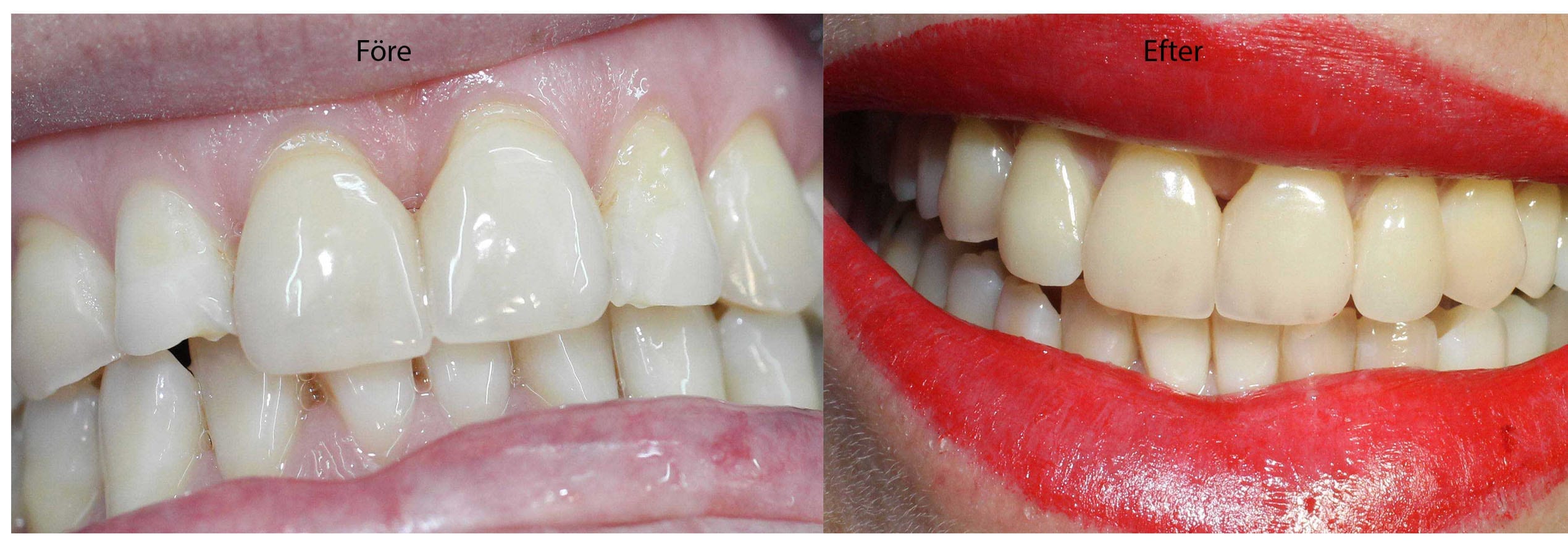 Före och efterbild på insättning av porslinsfasad