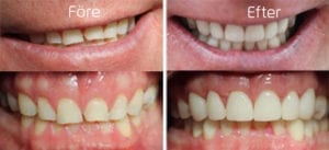 Porslinskronor i både över- och underkäke Före och efter porslinskronor i både över- och underkäke