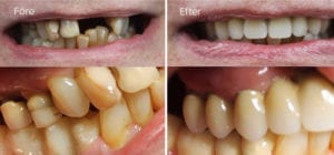 Full tandbro i överkäke och en delbro i underkäken Före och efter full tandbro i överkäke och en delbro i underkäken