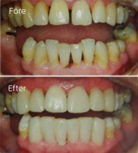 Compositfasader i fronten Före och efter compositfasader i fronten