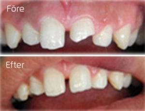 Lagning med compist framtand Före och efter lagning med compist framtand