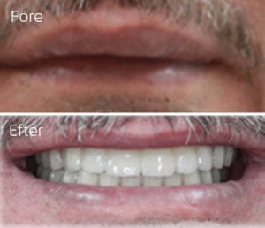 Implantatbroar i överkäke och underkäke Före och efter implantatbroar i överkäke och underkäke
