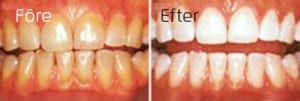 Tandblekning tandblekning före efter