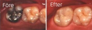 Porslinsonlay på kindtand Före och efter porslinsonlay på kindtand