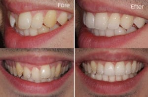Porslinsbro(i Zirkonium) i underkäken Före och efter Porslinsbro(i Zirkonium) i underkäken