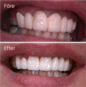 Omgörning av bro i överkäksfronten Före och efter omgörning av bro i överkäksfronten