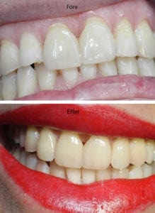 Porslinsfasader på två sidotänder (lateraler) i överkäken Före och efter porslinsfasader på två sidotänder (lateraler) i överkäken