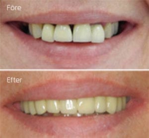 Porslinsbro i metallkeramik i överkäken Leende före och efter porslinsbro i metallkeramik i överkäken