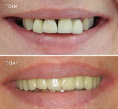 Före och efterbild på ett leende