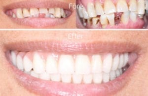 Hannes-fall2-400x260_opt Leende för och efter