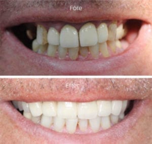 Helbro i metallkeramik Leende. Före och efter helbro i metallkeramik