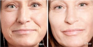 pat-2-400x203_opt Före efter bild kvinnligt ansikte