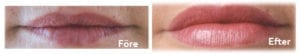 Behandling med Stylage fillers Läppar för och efter behandling med Stylage fillers