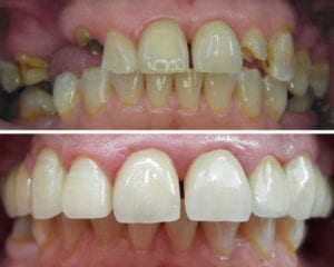 Nya tänder med tandkronor och tandbroar före efter bild på tandrad