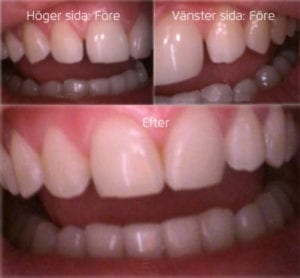 Lagning med composit framtänder Före och efterbilder. Lagning med composit framtänder