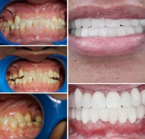 Full bettrehabilitering med hjälp av porslinsbroar och porslinskronor Före och efter bettrehabilitering med hjälp av porslinsbroar och porslinskronor