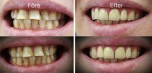 tandlakare-trangsund Före efter porslinskronor i överkäksfronten