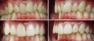 Tandställning i överkäke med Inman Aligner Före och efter tandställning i överkäke