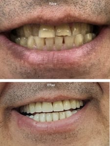 porslinskronor porslinsfasader skalfasad Före och efterbild porslinskronor och fasader