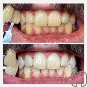 image0 Två närbilder av en patients tänder före och efter tandblekning och estetisk behandling som förbättrar färg och symmetri.