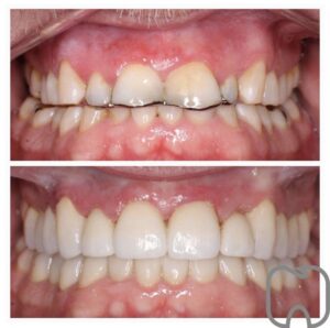 tandläkare stockholm Två bilder av en patients överkäke som visar tänder före och efter tandvårdsbehandling med estetisk förbättring av tandform och färg.