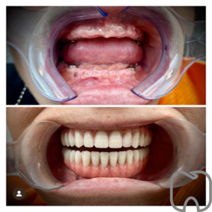 tandläkare stockholm tandimplantat