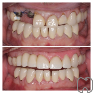 tandimplantat Två bilder av en patients tänder som visar implantat och tandkronor före och efter tandbehandling med förbättrad estetik och funktion.