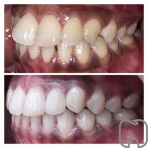 osynlig tandställning ClearCorrect tandställning