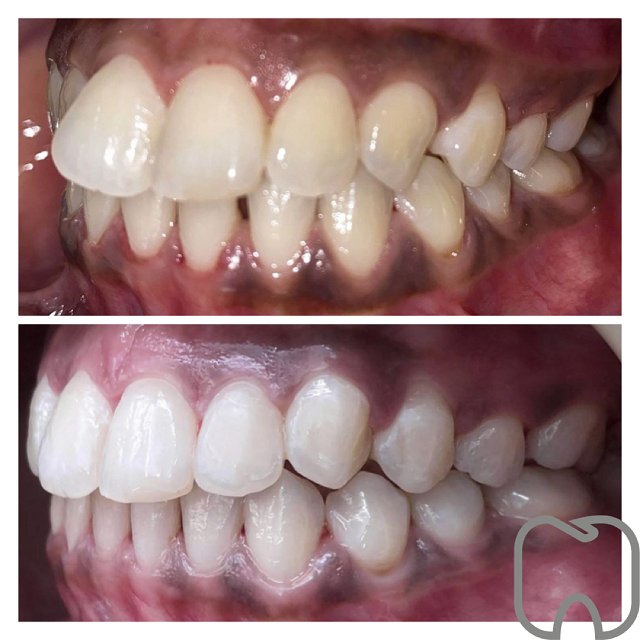 osynlig tandställning ClearCorrect tandställning