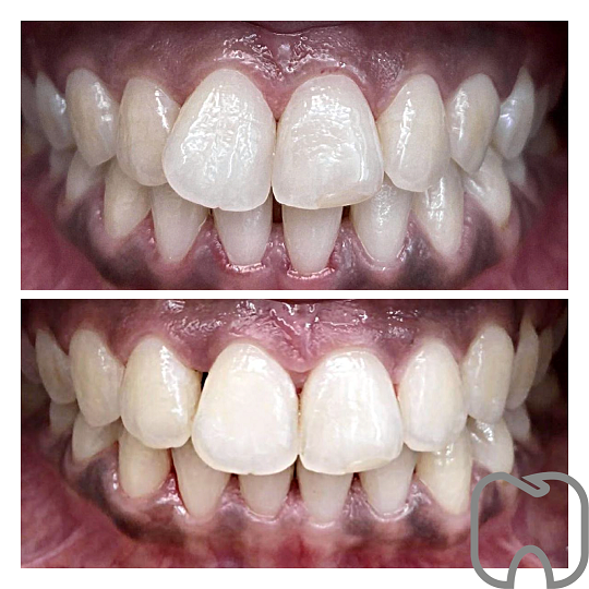 osynlig tandställning resultat från osynlig tandställning för vuxna