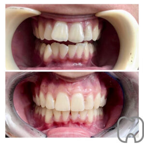 image0 Före- och efterbild av en patients tänder som visar en tydlig förbättring av bett och tanduppställning efter tandreglering.