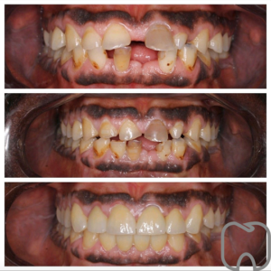 Tandea Tre bilder av en patients tänder som visar före, under och efter en tandbehandling med rekonstruktion och förbättrade tandytor.