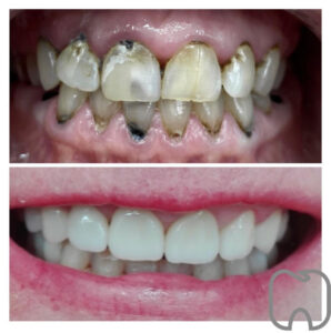 image0 Före- och efterbild av en patients tänder som visar en dramatisk förbättring efter omfattande tandvårdsbehandling.