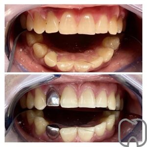 tandläkare stockholm Före- och efterbild av en patients tänder som visar resultat av tandblekning eller tandvårdsbehandling.
