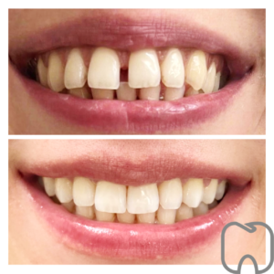 osynlig tandställning Före- och efterbild av en persons leende som visar tydlig förbättring av tändernas utseende efter tandvårdsbehandling.