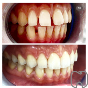 osynlig tandställning Före- och efterbild av en patients tänder som visar förbättring av tandhälsa efter tandvårdsbehandling.