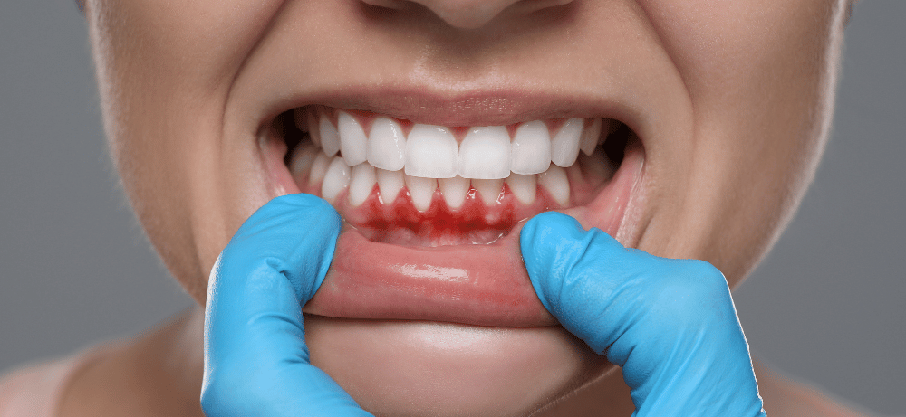 Patient med tandköttsinflammation