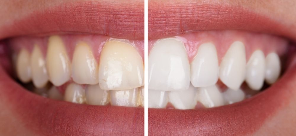 gula frätskadade tänder